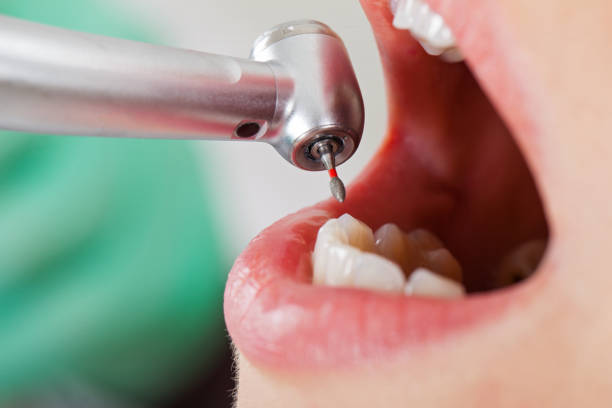 Best Emergency Wisdom Teeth Removal in Canyon, TX